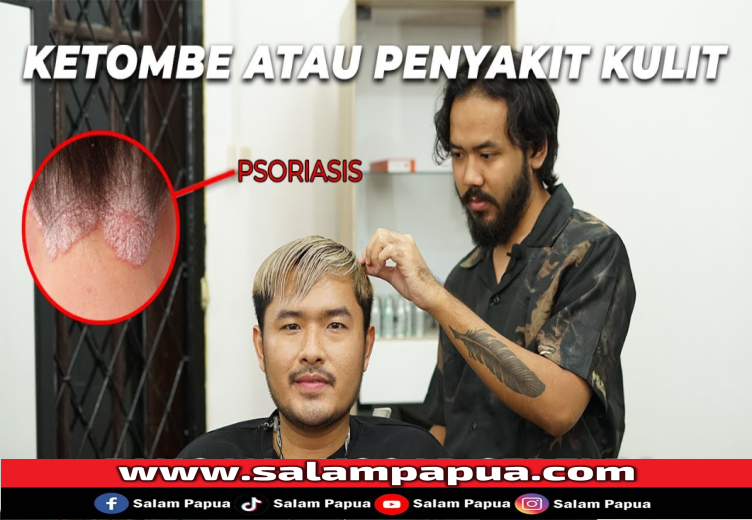 Kenali 5 Penyebab Ketombe Dan Cara Mengatasinya