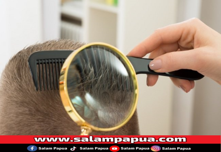 5 Cara Menghilangkan Kutu Rambut Dengan Mudah