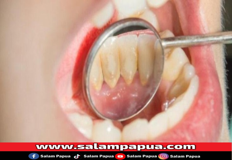 12 Cara Menghilangkan Karang Gigi Secara Alami Sendiri Di Rumah