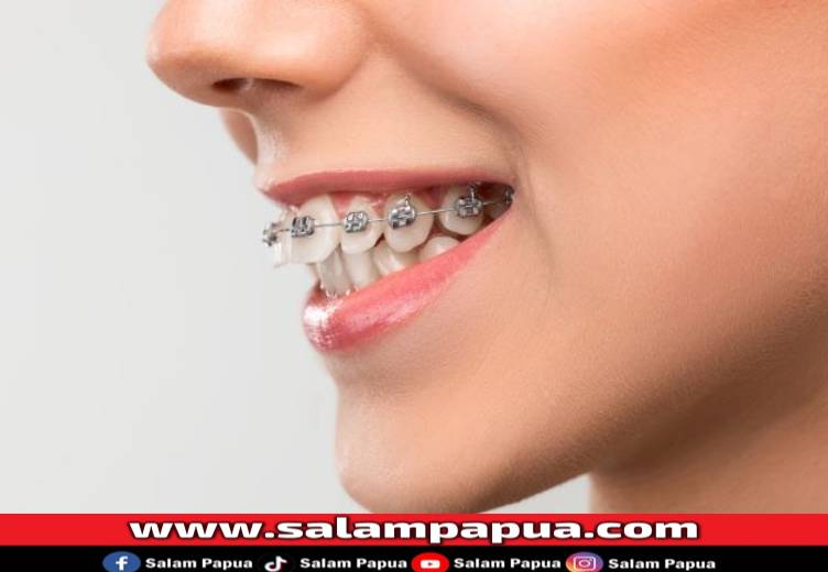 4 Cara Memundurkan Gigi Tonggos