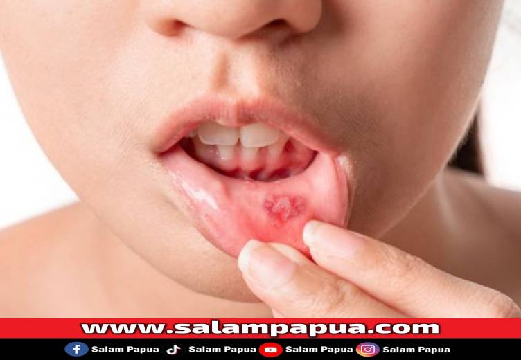 11 Makanan Untuk Menyembuhkan Sariawan Yang Bernutrisi