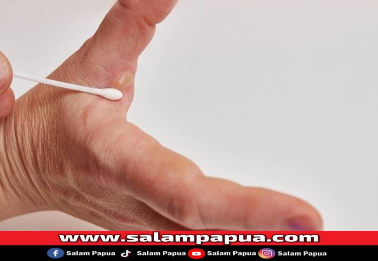 6 Obat Luka Bakar Melepuh Yang Ampuh