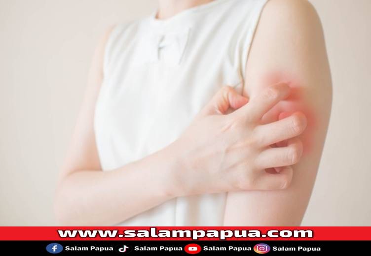 Pertolongan Pertama Alergi Obat Yang Harus Diketahui