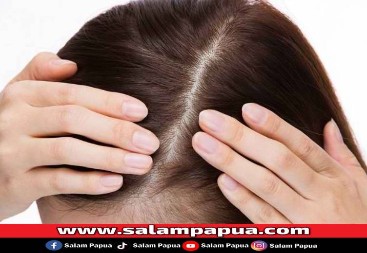 7 Penyakit Kulit Kepala Yang Perlu Diketahui