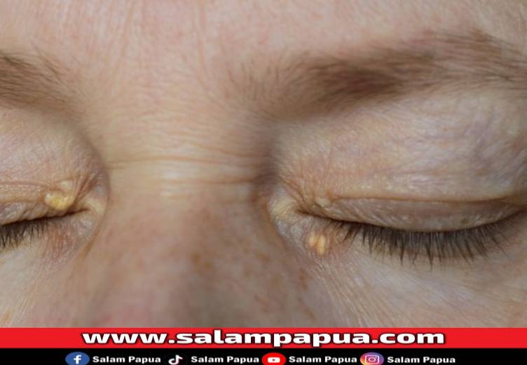 Cara Menghilangkan Lemak Mata Secara Alami Dan Medis