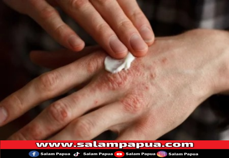 9 Obat Eksim Tradisional Ampuh Sembuhkan Gejalanya