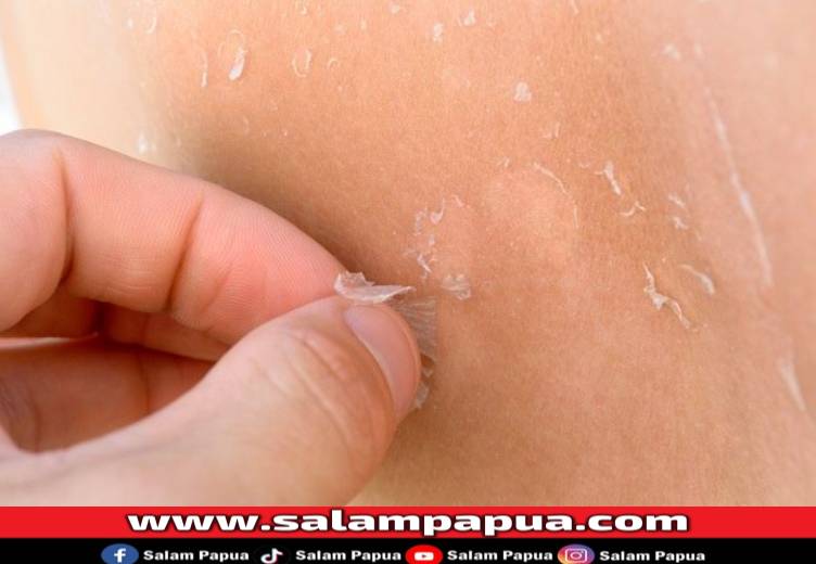 8 Cara Menghilangkan Kulit Mengelupas Dengan Cepat