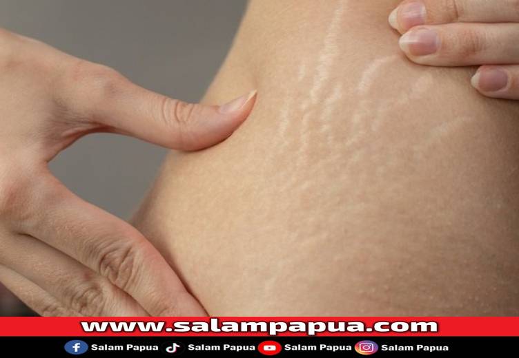 7 Cara Menghilangkan Stretch Mark Secara Alami