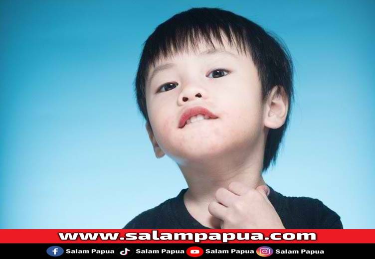 9 Penyakit Kulit Pada Anak Yang Sering Terjadi