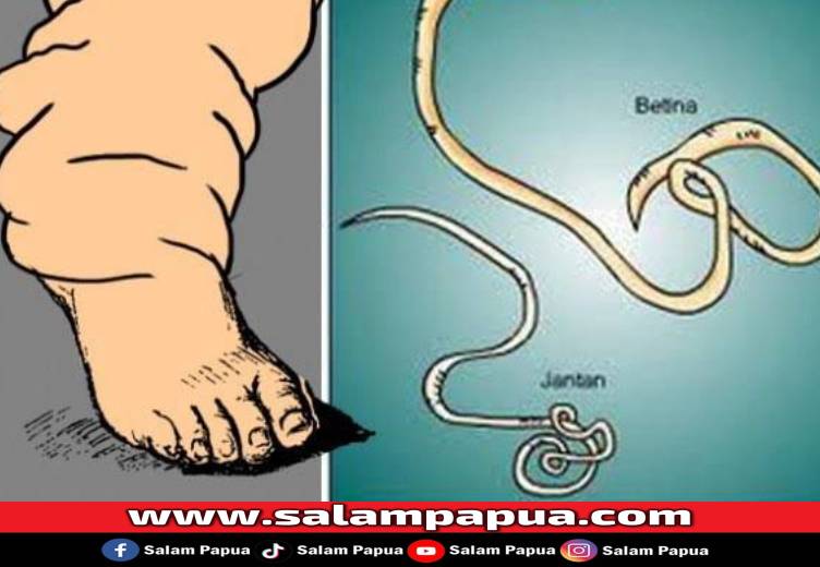 Enam Kasus Kaki Gajah Ditemukan, Dinkes Mimika Siapkan Langkah Pencegahan