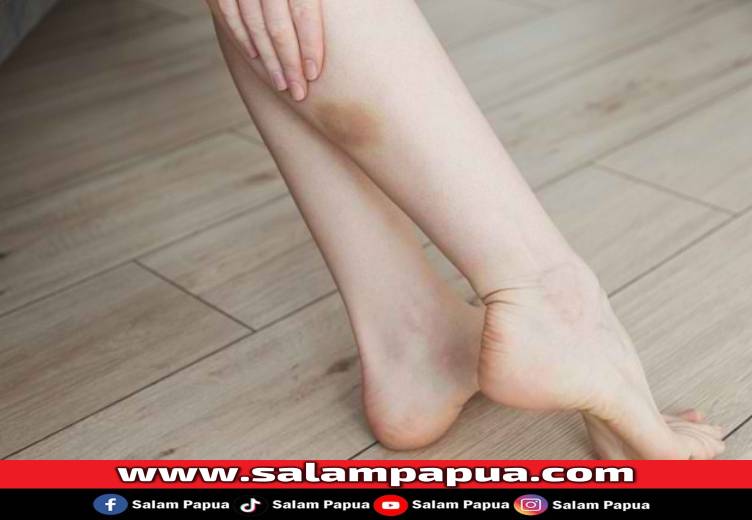 Waspadai Memar Tanpa Sebab Dan Cara Penanganannya