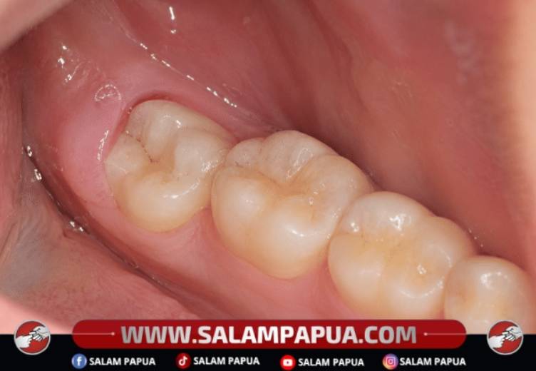 Mengenal Geraham Bungsu, Gigi Terakhir Yang Tumbuh Saat Dewasa