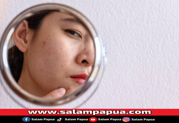 Ini 7 Cara Menghilangkan Bekas Noda Hitam Jerawat Dalam Semalam